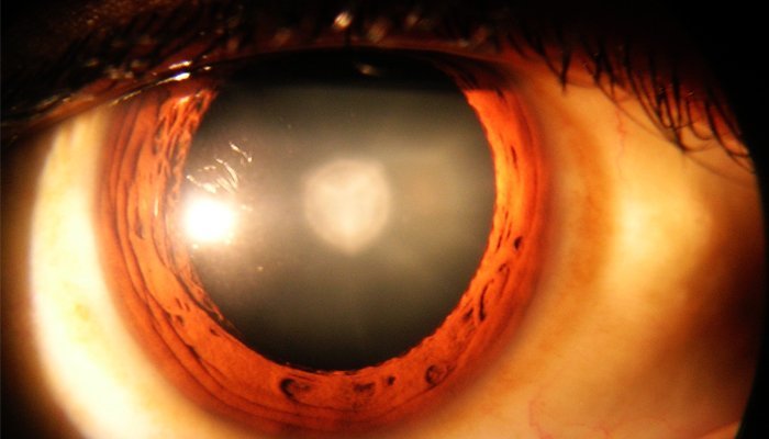 Cataract treatment in Ayurveda