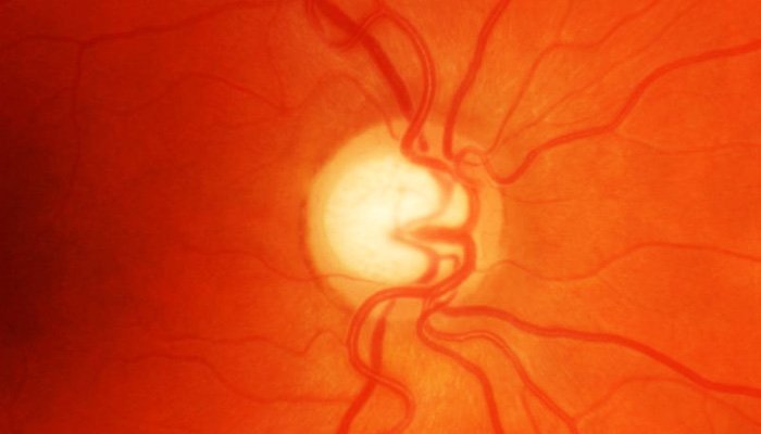 Treatment for Glaucoma in Ayurveda