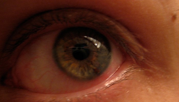 Conjunctivitis treatment in Ayurveda