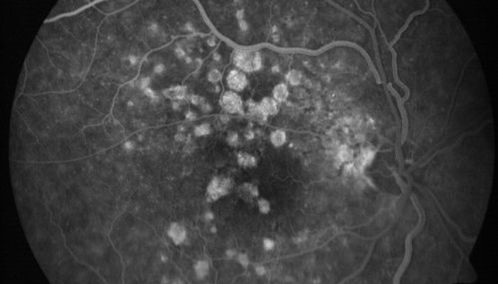 Ayurveda treatment for Age-related Macular Degeneration
