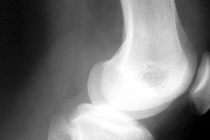 Free Bone Density Camp-Itoozhi Ayurveda