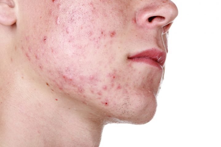Ayurvedic Treatment to Acne: Effective Home Remedies