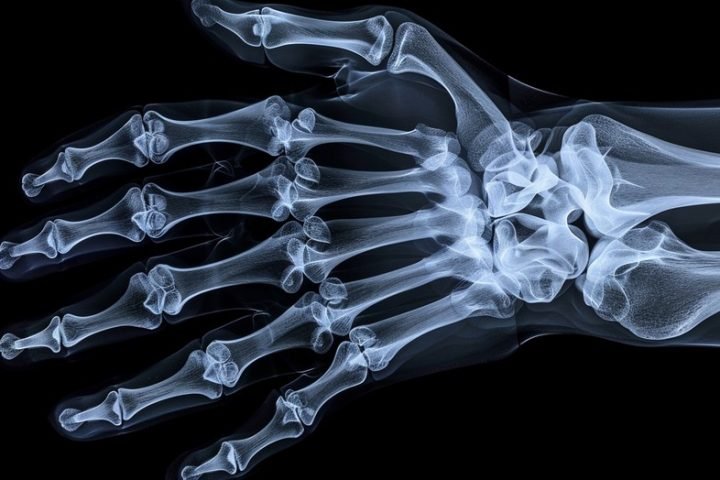 Free Bone Mineral Density Test Camp at Itoozhi Ayurveda